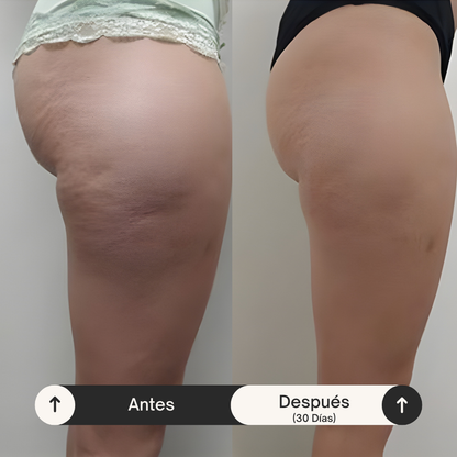 Sireva | Aceite Anti-Celulitis Natural